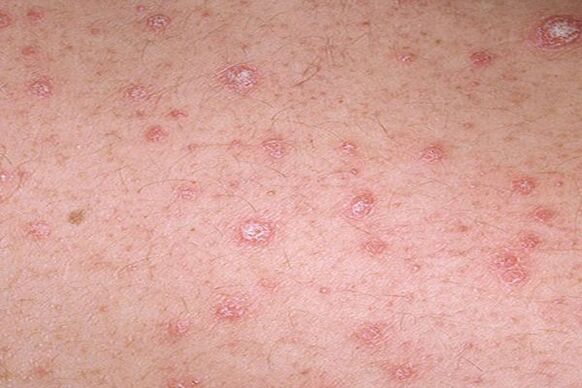 Psoriasis: symptômes chez les adultes et les enfants, comment il ...